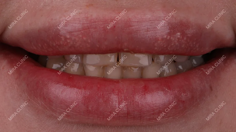 Unsatisfactory Smile After Braces
